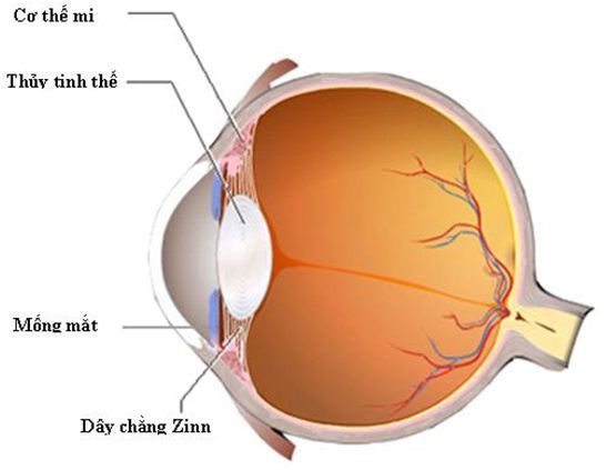 bệnh đục thủy tinh thể