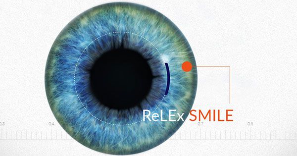 phẫu thuật smile