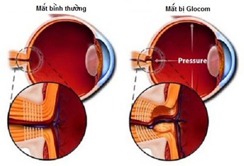 triệu chứng glocom