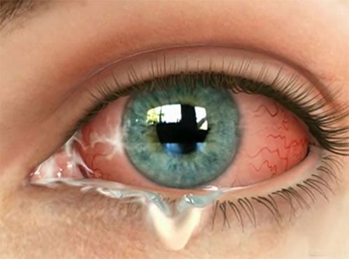 viêm kết mạc cấp tính